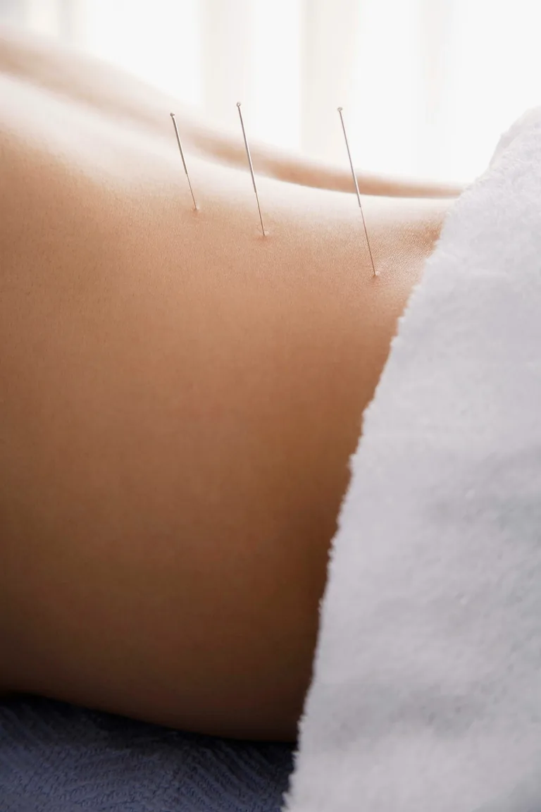 Acupuncture